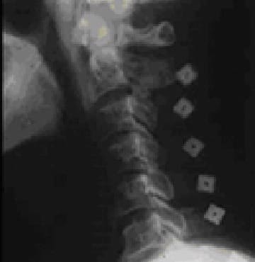 頚椎椎間板ヘルニア