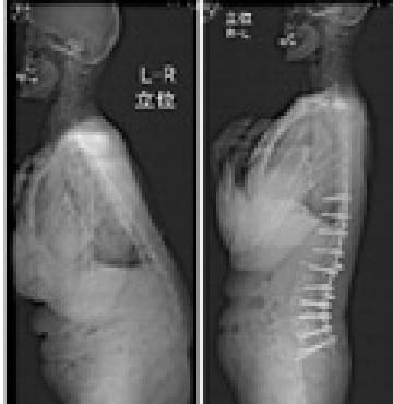 腰椎変性後側弯症（成人脊柱変形）