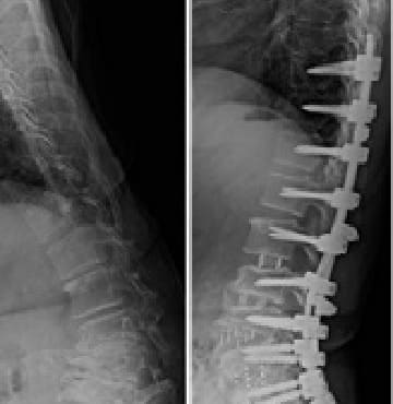腰椎変性後側弯症（成人脊柱変形）
