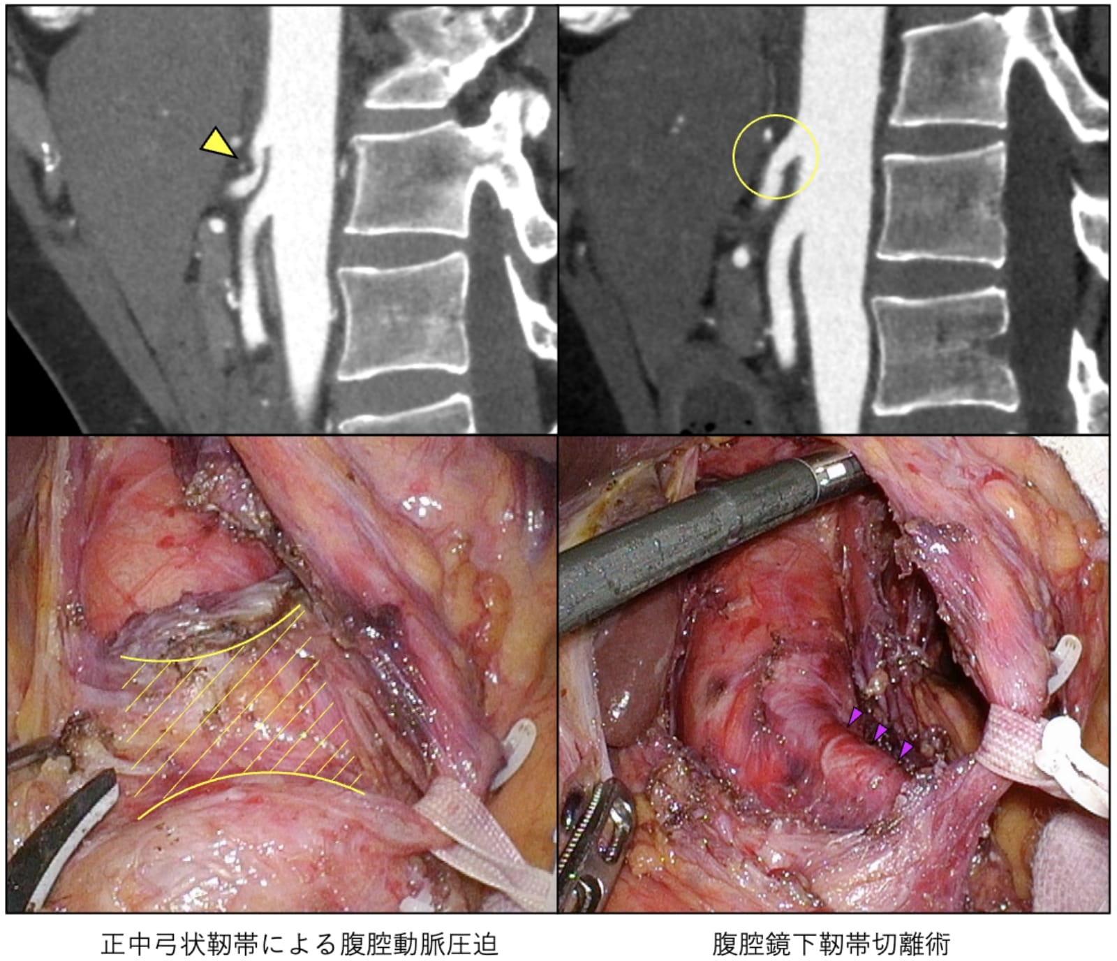 腹部内臓動脈瘤に対する手術