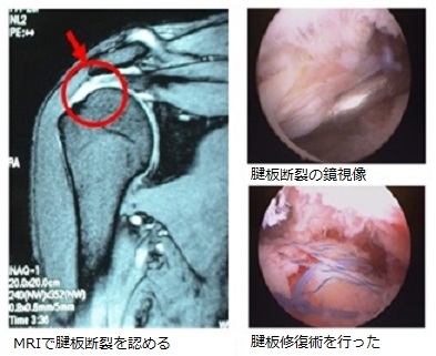 関節鏡視下手術の適応となる主な疾患